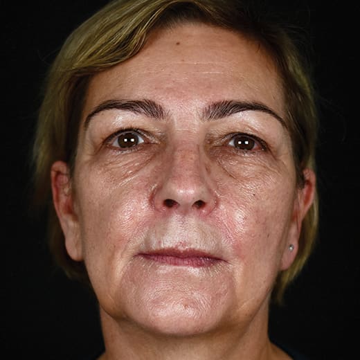 non-surgical facelift after