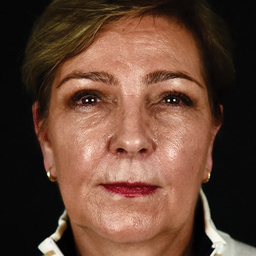 non-surgical facelift before