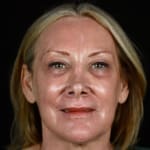 laser skin resurfacing after