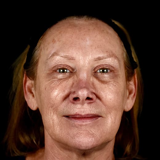 laser skin resurfacing before
