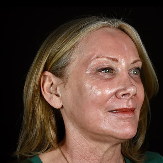 laser resurfacing after