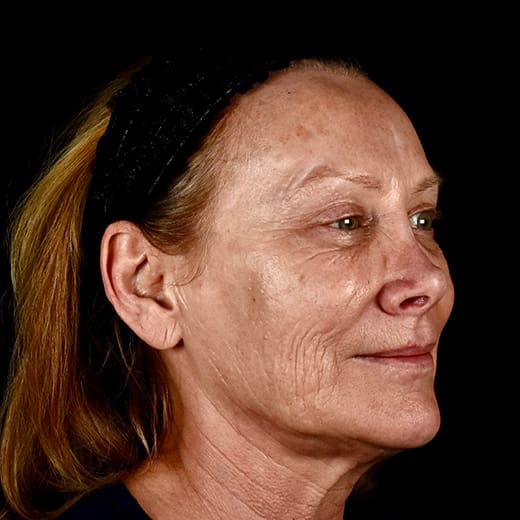 laser resurfacing before