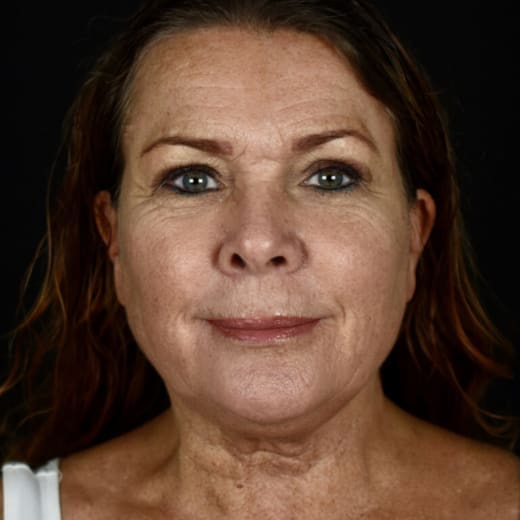Laser Resurfacing Irvine