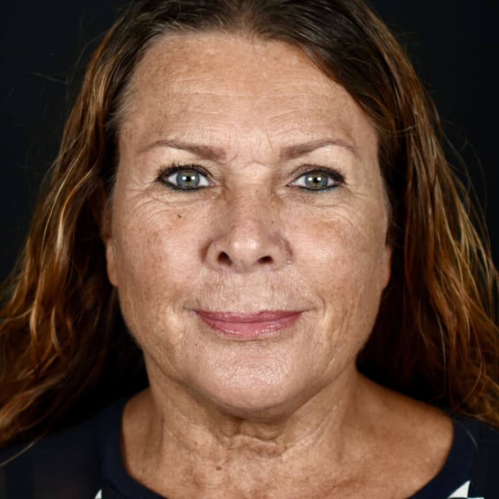 Laser Resurfacing Irvine