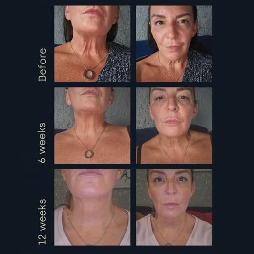 Patient before and 12 weeks after Sofwave treatment.