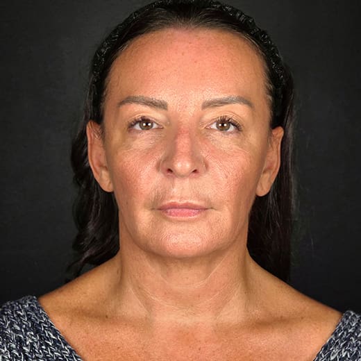 Patient before Sofwave treatment